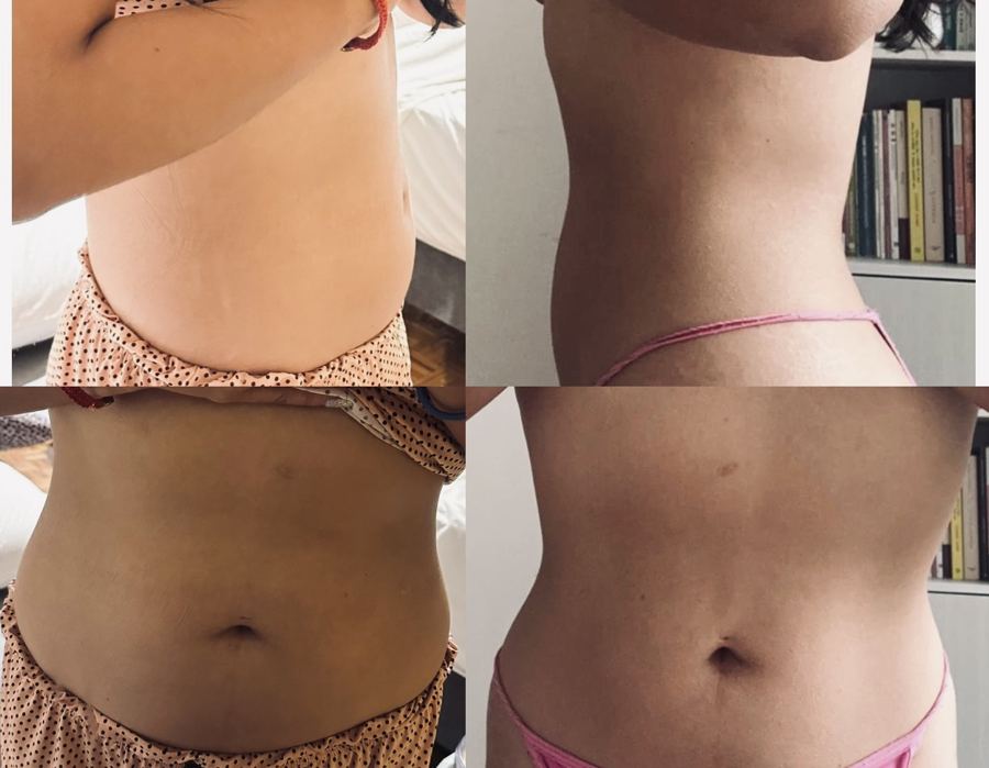 Antes y después del abdomen de Marisa